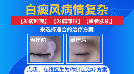 女孩手背白癜风三年了能治好吗 白斑怎么治
