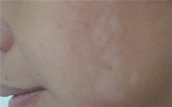 面部白斑图片 脸部白癜风怎么治