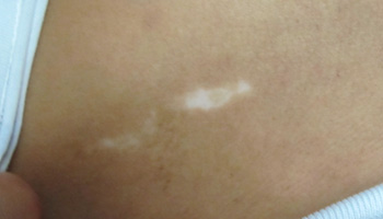 儿童初期长白斑图片 白斑可以自愈吗