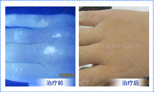 手部有白斑治疗过一年效果不好还有其他方法吗
