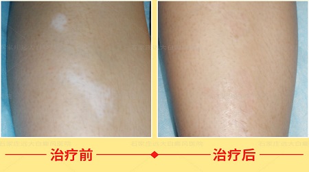 腿上一个黄豆大小的白块