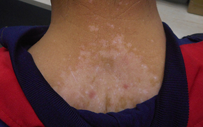 5岁小孩背上有很多小白点像是白癜风怎么判断