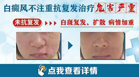 白癜风复发有什么特点