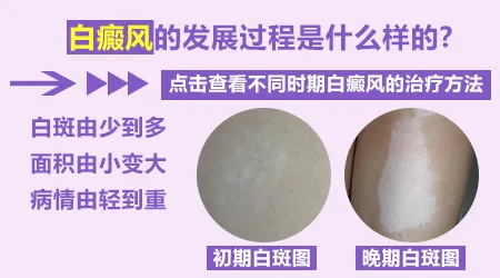 脖子上的白斑面积变大是不是处于发展期