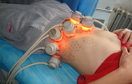 皮肤白斑做种植怎么收费 贵不贵