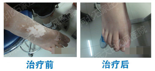 308激光后白斑的恢复变化图