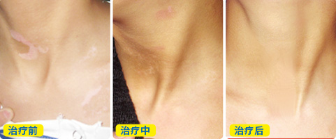 脖子上又长了几个白点是什么