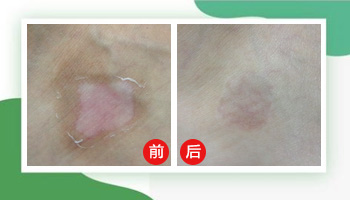 家用白癜风光疗机照白斑效果