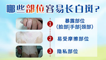 白癜风长在阴茎上是怎么回事