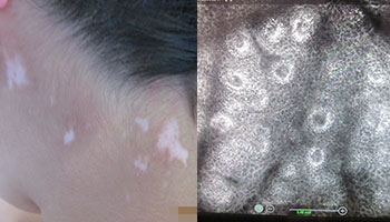 脸部早期白癜风症状图片是什么样