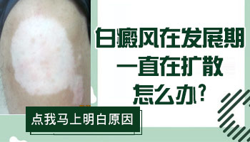胸上和脸上白癜风半年多了有扩散