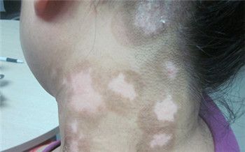 小孩长白癜风的图片