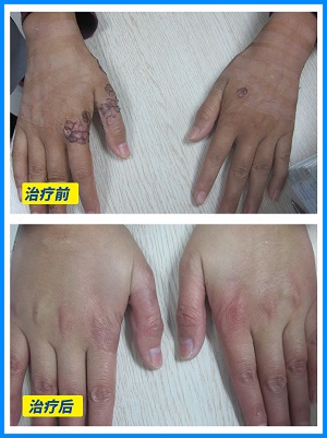 无花果叶治疗白癜风是鲜叶还是干叶