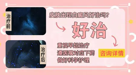 石家庄哪个医院看白癜风效果很好