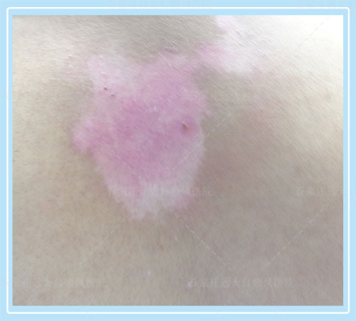 白癜风被晒后成粉红色怎么办