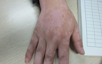 手上的皮肤有一块白的是怎么回事