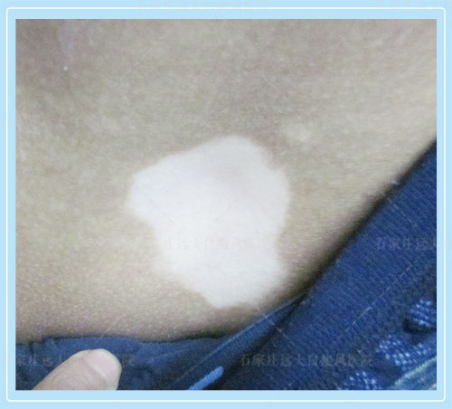 打疫苗会不会出现皮肤长白斑的情况