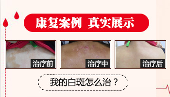 石家庄靠得住的白癜风医院