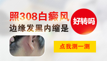 白斑照308激光内缩图片