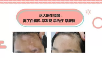 做什么检查可以确定白癜风的病因