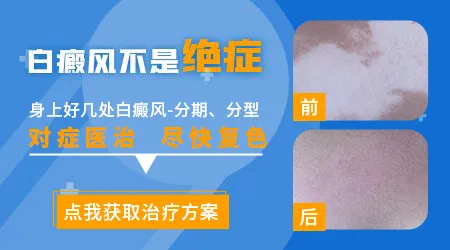 早期白癜风能治好吗 把握黄金治疗期