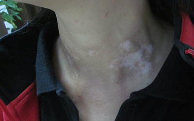 新生儿脖子褶皱处发白图片