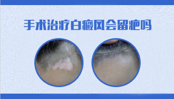 小面积白癜风植皮后会留疤吗