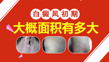 儿童面部白癜风的早期症状都有哪些