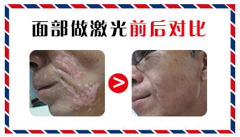 冬天白癜风做种植好还是照光好