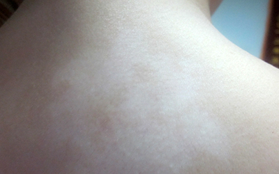 为什么孩子后背有白色的小点