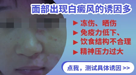 导致白癜风的原因有什么