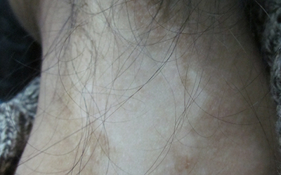 脖子上边挨着头发的位置长白癜风怎么治