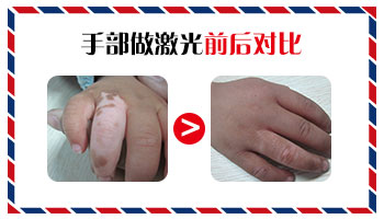 ZUI近手指关节处出现白斑是咋回事