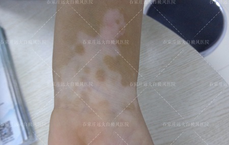 手臂白癜风早期症状图片