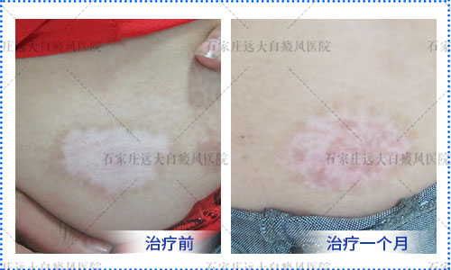 下巴白癜风光疗是先抹药还是照光后抹药