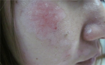 孩子脸上长白斑怎么回事 白斑是什么