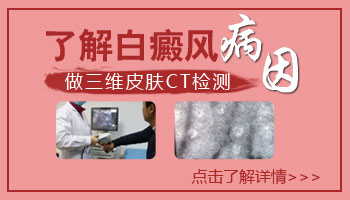 伍德灯检查白癜风的原理