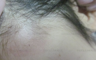 孩子脖子处有一白的怎么回事