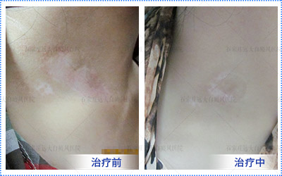 什么症状表明晕痣在好转