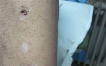 大腿上有一处白色的皮肤跟别的皮肤不一样