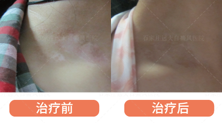 白癜风照光的时候需要遮盖好皮肤吗