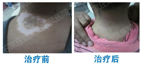 得了白癜风可以用磨砂膏吗