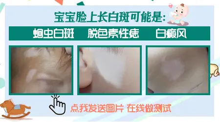 小孩脸上有白斑是因为肚子里有蛔虫吗