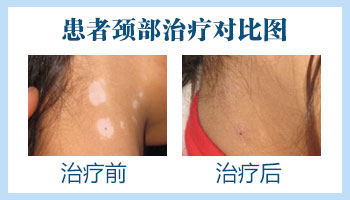 石家庄治疗白癜风ZUI好的医院[治疗白癜风专科医院排名]