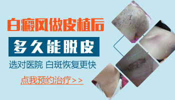 白癜风植皮 白斑皮肤一步一步变化的图片