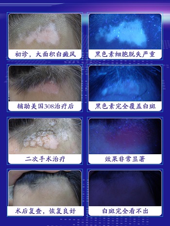 河北省哪里治白癜风医院好