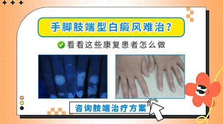 手脚末端的白癜风是不是治不好