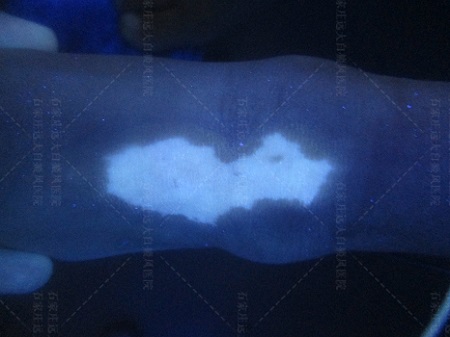 白癜风初期图片特点是什么