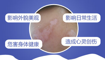 白癜风会给人带来哪些影响