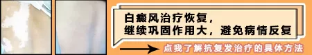 白癜风边缘有黑色素岛还要多久恢复